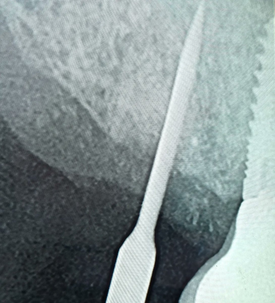 avendanodr's tweet photo. Daily Floss News 397 #mismeetteam, #MISImplants #C1, #perioimplant, #avendanodr
Cirugía y colocación de implante MIS C1, por Dr Adrián Avendaño y rehabilitacion protesica de implante, por Dr Rony Rivera https://t.co/S8zUfjHDXg