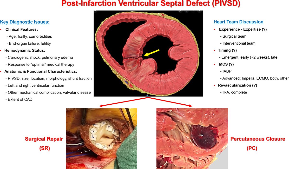 ehj_ed's tweet photo. Management of Post-Infarction Ventricular Septal Defects: Are We Moving Forward?
https://t.co/K8sIKzJH05
#AMI #PIVSD #cardiotwitter @escardio @ESC_Journals https://t.co/viDxB6fpun