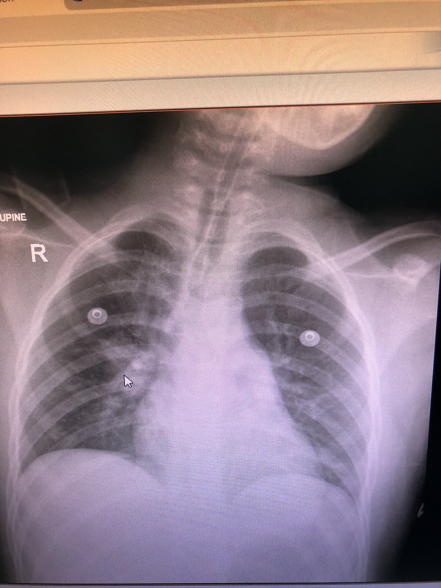 Linda Riemer On Twitter 7yo Girl Gets Admitted Overnight In Our PICU 