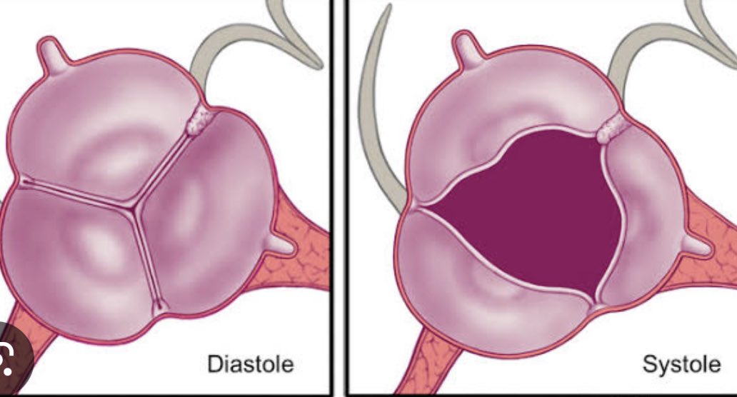 If a patient has forme fruste aortic valve (partial fusion), what is the cut off asendan aort diameter for aortic surgery 50 mm or 55 mm? #echofirst #CardioTwitter