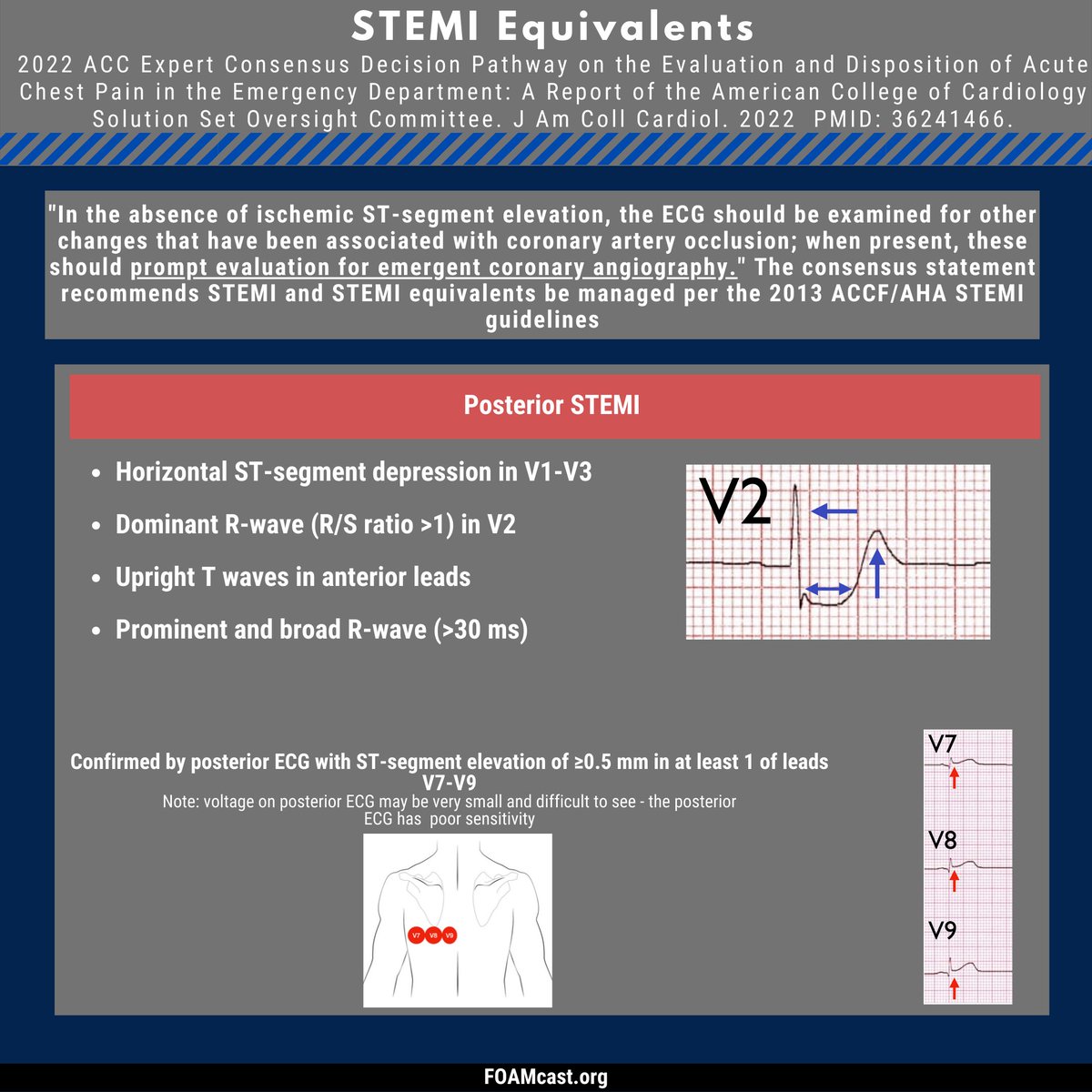 FOAMcast (@foampodcast) on Twitter photo Summary of the new <a href="/ACCinTouch/">American College of Cardiology</a> statement
⭐"STEMI" binary misses patients with occlusion MI (<a href="/smithECGBlog/">Stephen W. Smith</a> <a href="/PendellM/">Pendell Meyers</a> have been saying this for years)!
⭐STEMI equivalents should be treated as STEMI
Podcast:bit.ly/3CLpV6W
Blog:bit.ly/3ER2oUJ 🧵 (1/X) Summary of the new <a href="/ACCinTouch/">American College of Cardiology</a> statement
⭐"STEMI" binary misses patients with occlusion MI (<a href="/smithECGBlog/">Stephen W. Smith</a> <a href="/PendellM/">Pendell Meyers</a> have been saying this for years)!
⭐STEMI equivalents should be treated as STEMI
Podcast:bit.ly/3CLpV6W
Blog:bit.ly/3ER2oUJ 🧵 (1/X)