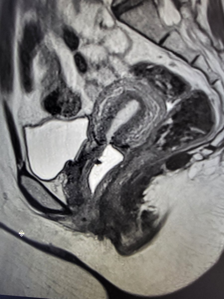 LetDdiceFlyHigh's tweet photo. Trachelectomy is also called cervicectomy. The prefix "trachel-" comes from the Greek "trachelos" meaning neck. It refers to the cervix which is the neck of the uterus. #FOAMrad https://t.co/LOMh3QGngt