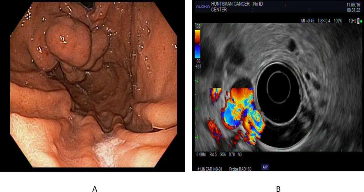 FrontGastro_BMJ's tweet photo. Read the excellent latest issue of @FrontGastro_BMJ online now via

https://t.co/X773eQ9hyg

or via

https://t.co/rga3mcdEXQ

#IBDTwitter #LiverTwitter #EndoTwitter #GITwitter #UEGWeek22 @RMBeattie50 @OTavabie @Dr_Dee_Kumar @drobeirne @AusDrGupta @jennie_clough @DCharabaty https://t.co/0kPI5y7o1E
