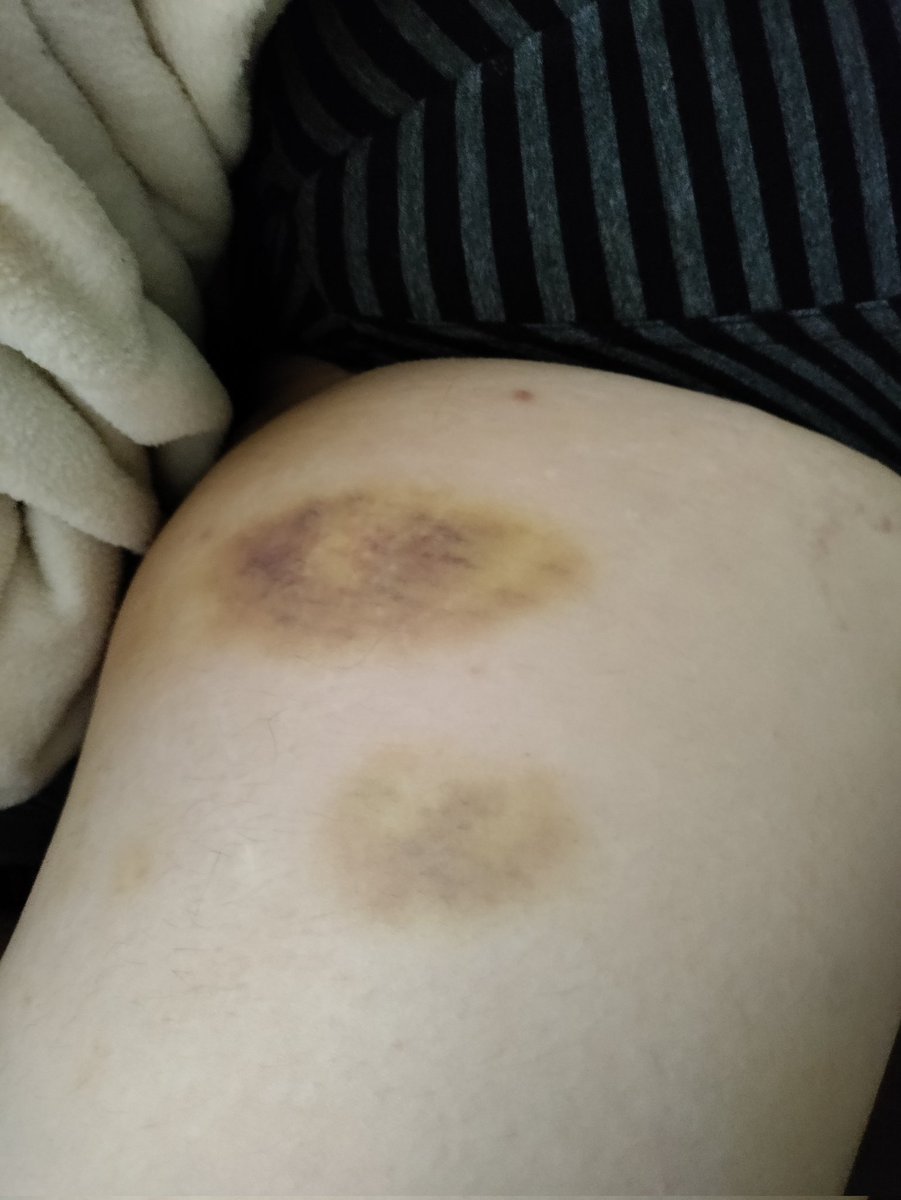 sirclaudius_'s tweet photo. bunny's bruises, four days later @faux_victory https://t.co/9zUZtrOBg9