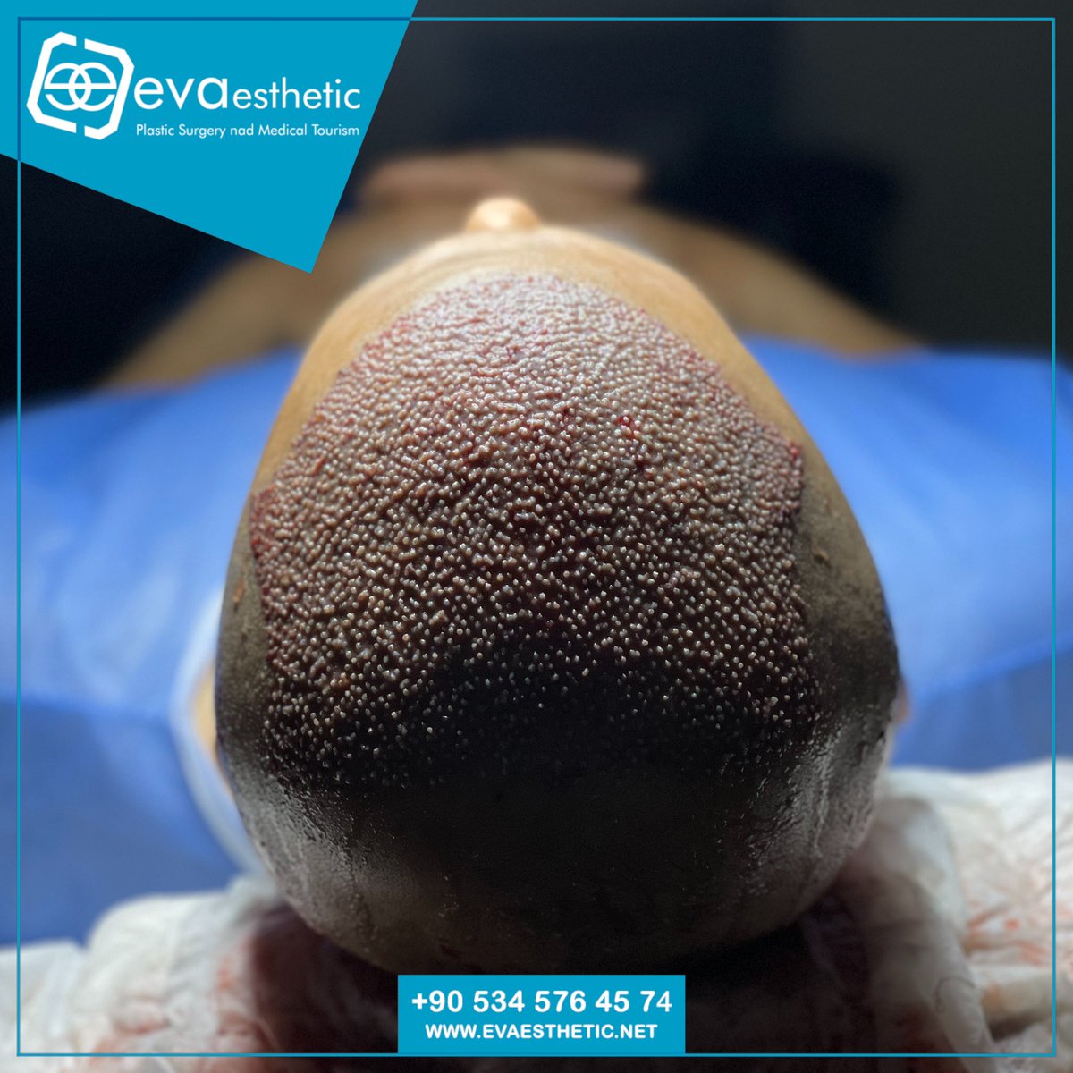 Eva Esthetic | Hair Transplant ✔️.
.
Hair transplantation in Turkey Istanbul
The best EVA Esthetic Hair Transplant Hospital In Istanbul 🇹🇷
-#HairTransplantation
-#ForeheadReduction
-#EyebrowTransplant
-#BeardTransplantation 🔗👇
Book now via📲:WhatsApp;📲 +905345764574
🇺🇸🇬🇧🇪🇸🇫🇷🇷🇴