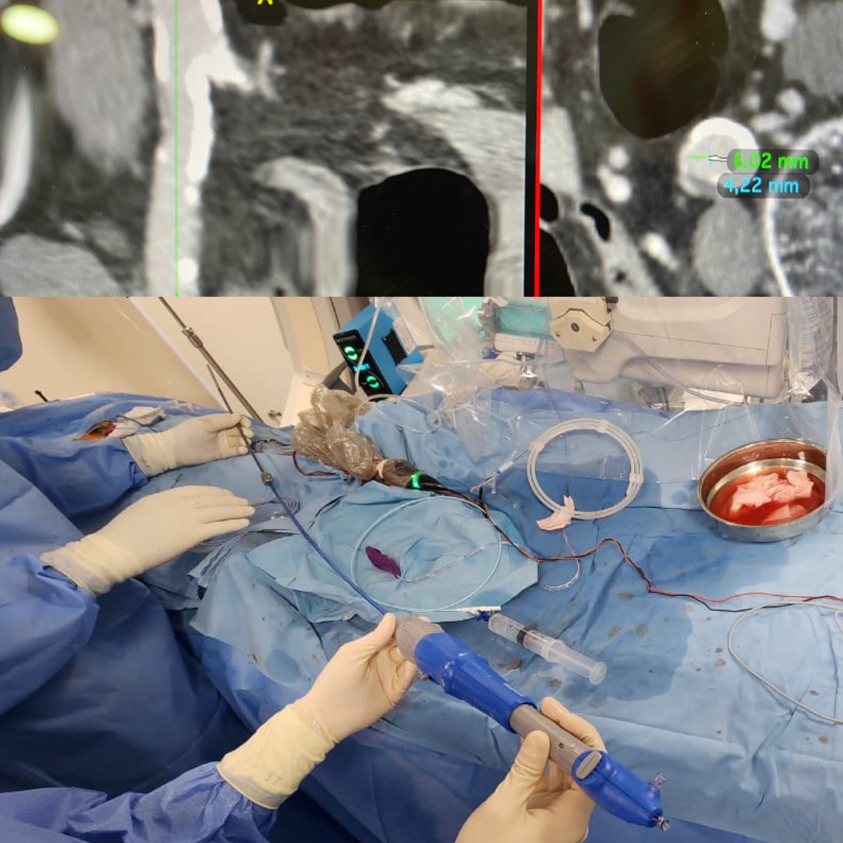 omendiz's tweet photo. Hoy #TAVI más #IVL para el acceso vascular https://t.co/SLUrwS9toy