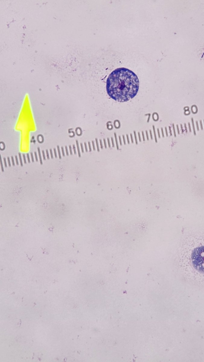 Marc Couturier PhD, D(ABMM) 🕷🦠🔬 (@parasite_power) on Twitter photo Cultured on a lawn of E. coli from the CSF of a meningoencephalitic patient that passed away. Stained with Giemsa from the plate. First time I have cultured Naegleria in my career. Sad to know this predictable but tragic outcome.
#parasitology
<a href="/ParasiteGal/">Bobbi Pritt, MD</a> Cultured on a lawn of E. coli from the CSF of a meningoencephalitic patient that passed away. Stained with Giemsa from the plate. First time I have cultured Naegleria in my career. Sad to know this predictable but tragic outcome.
#parasitology
<a href="/ParasiteGal/">Bobbi Pritt, MD</a>