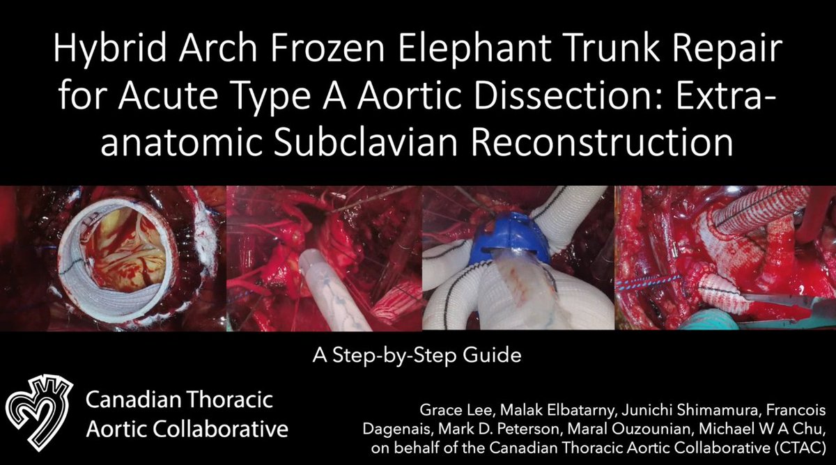 Junichi Shimamura (@shimamuramd) on Twitter photo Just published!
Hybrid arch frozen elephant trunk repair for acute type A aortic dissection: Extra-anatomic subclavian reconstruction
mmcts.org/tutorial/1749
<a href="/MichaelMwachu/">Michael Chu</a>
<a href="/OuzounianMD/">Maral Ouzounian</a>
<a href="/Mark_PetersonMD/">Mark</a>
<a href="/CtacSurg/">Canadian Thoracic Aortic Collaborative</a> Just published!
Hybrid arch frozen elephant trunk repair for acute type A aortic dissection: Extra-anatomic subclavian reconstruction
mmcts.org/tutorial/1749
<a href="/MichaelMwachu/">Michael Chu</a>
<a href="/OuzounianMD/">Maral Ouzounian</a>
<a href="/Mark_PetersonMD/">Mark</a>
<a href="/CtacSurg/">Canadian Thoracic Aortic Collaborative</a>