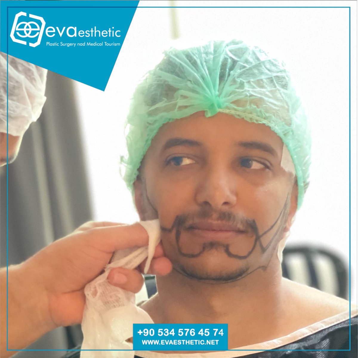 Eva Esthetic | beard  Transplant ✔️.
Hair transplantation in Turkey Istanbul
The best EVA Esthetic Hair Transplant Hospital In Istanbul 🇹🇷
-#HairTransplantation
-#ForeheadReduction
-#EyebrowTransplant
-#BeardTransplantation 🔗👇
Book now via📲:WhatsApp;📲 +905345764574
🇺🇸🇬🇧🇪🇸🇫🇷🇷🇴