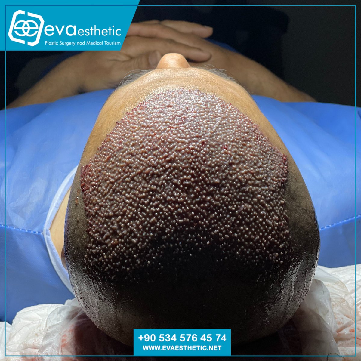 افضل كثافة شغر طبيعي خط ملائم للوجه فقط في #ايفا_استاتيك 
 استشارة طبية عبر :
 Call : 00905345764574 📱
💯WhatsApp Dercet : (bit.ly/2T3QtuF) 🌏
🌐 evaesthetic.net 
#زراعة_شعر #زراعة_الشعر #زراعة_اللحية #زراعة_الحاجب  #hairtransplant #Hair