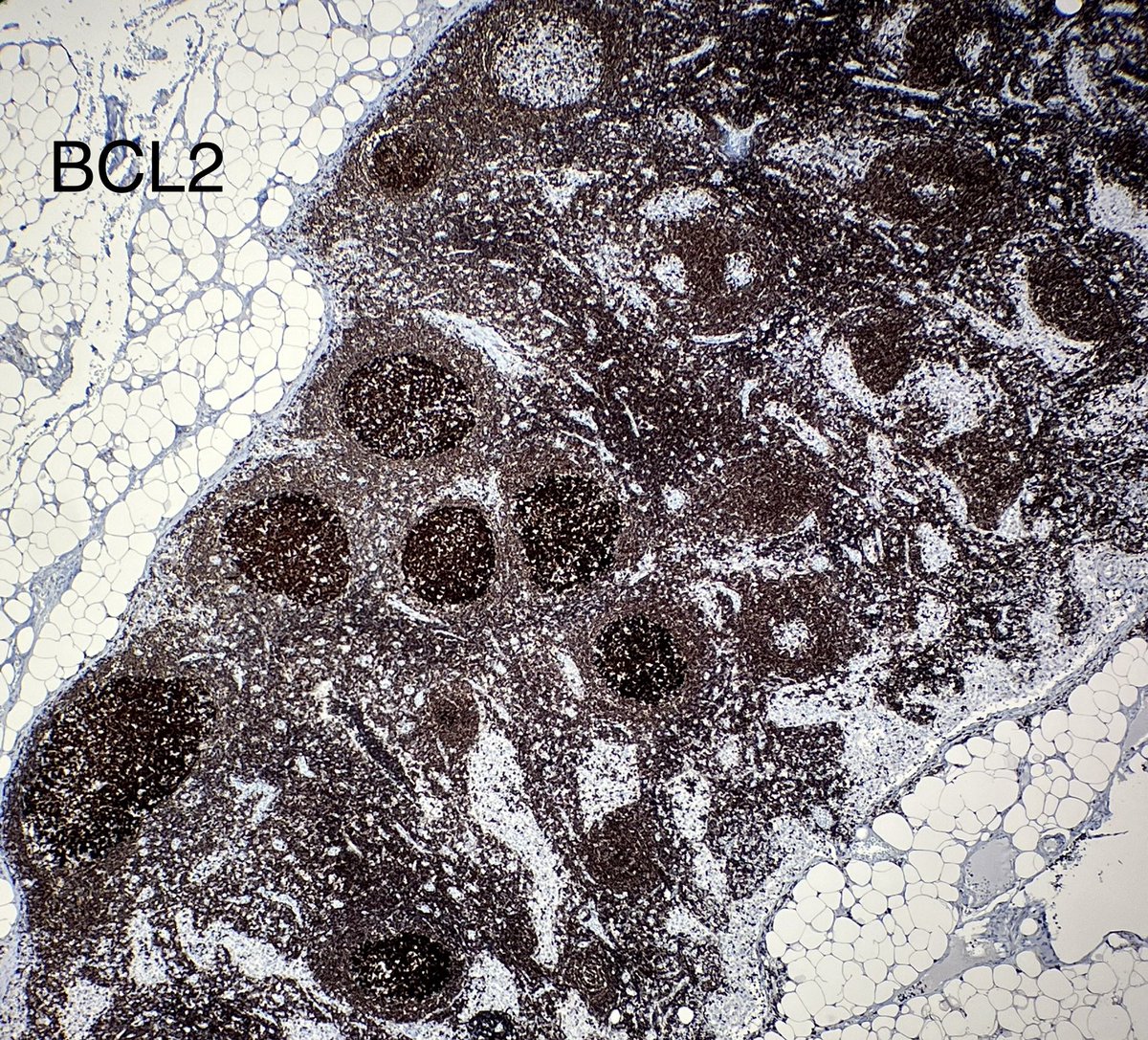NanaMatsumoto8's tweet image. Tiny tiny lymph node that looked a little bit monotonous… what would you call it?  #hemepath #PathTwitter @kirillkarlin