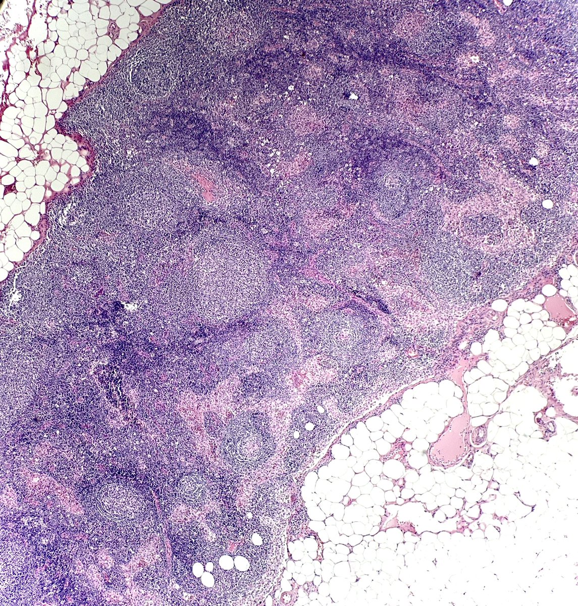NanaMatsumoto8's tweet image. Tiny tiny lymph node that looked a little bit monotonous… what would you call it?  #hemepath #PathTwitter @kirillkarlin