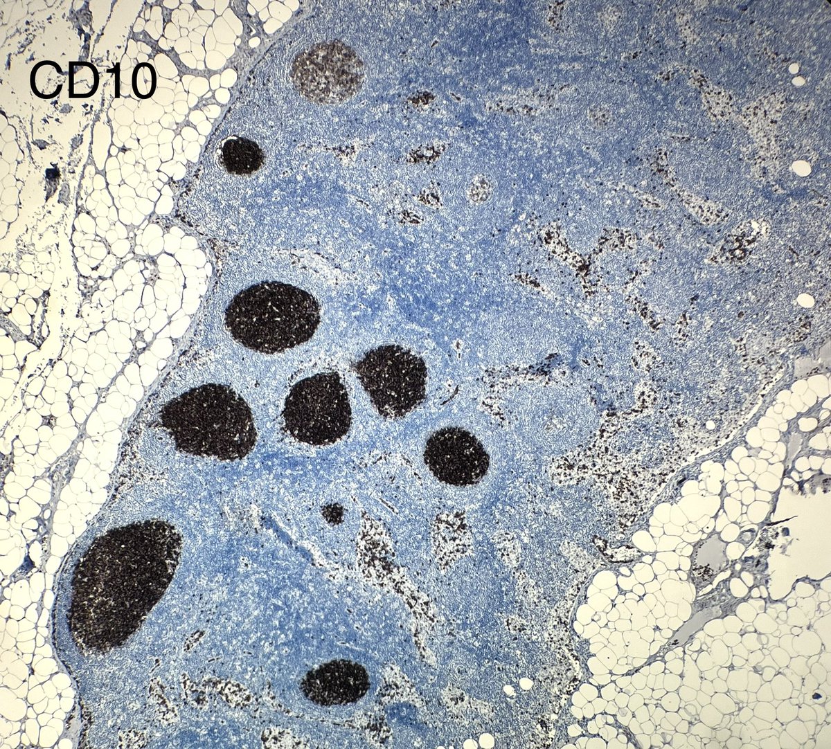 NanaMatsumoto8's tweet image. Tiny tiny lymph node that looked a little bit monotonous… what would you call it?  #hemepath #PathTwitter @kirillkarlin