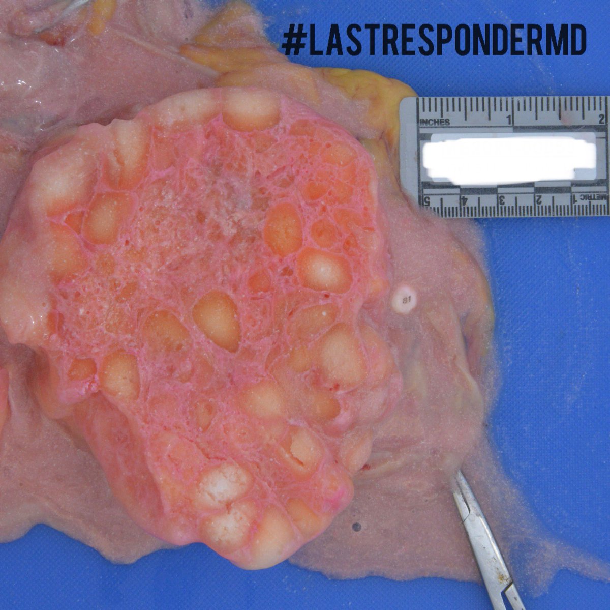 MdResponder's tweet photo. Great example. Any trainee want to comment where we are and what we are looking at? How about the stellar resident from @NU_Pathology I worked with the last two days? @AlcinoGama @krupam_md #4n6 https://t.co/kbJGYS2ZOL