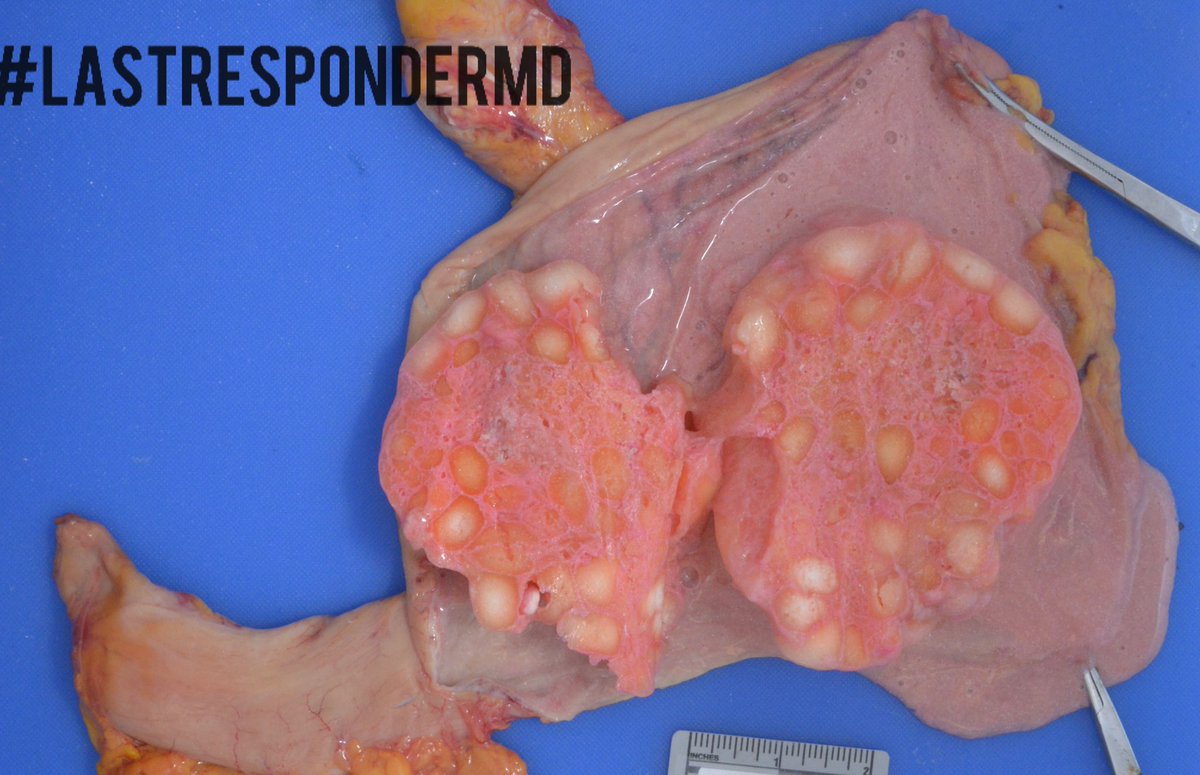MdResponder's tweet photo. Great example. Any trainee want to comment where we are and what we are looking at? How about the stellar resident from @NU_Pathology I worked with the last two days? @AlcinoGama @krupam_md #4n6 https://t.co/kbJGYS2ZOL