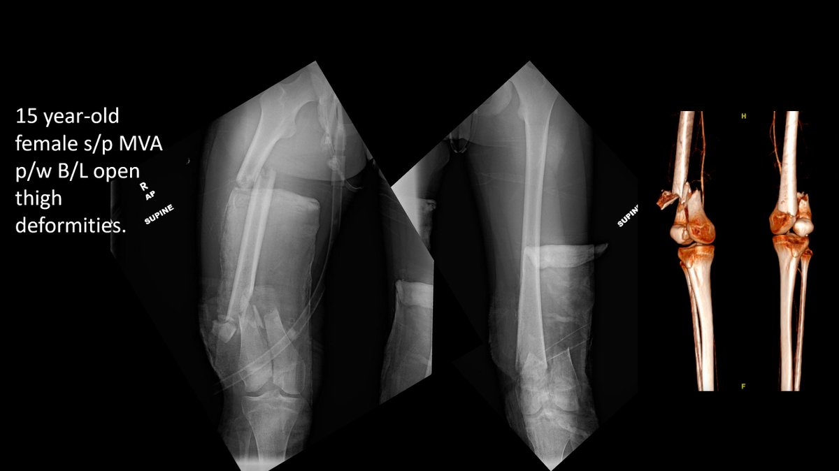 otatrauma's tweet photo. Join us tomorrow evening for Fracture Night with Dr. Christopher Lee. Session begins at 8:00PM CT. If you have not previously attended an event, register by using the provided link: https://t.co/QIHKGI6whL https://t.co/lOUeX4U6ur