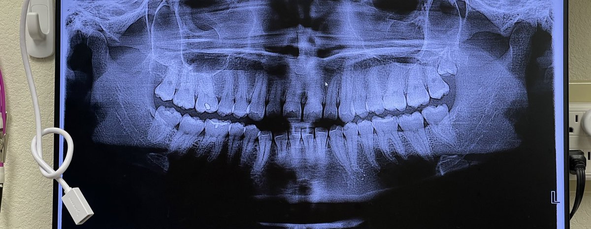 ziraa67's tweet photo. I have.. an extra wisdom tooth ??.. 😭 theres only a 2% chance of having supernumerary teeth. 

the pain is severe but I’ll be getting it removed thursday so only suffering for a little bit longer. https://t.co/Ux9AR0V1RQ