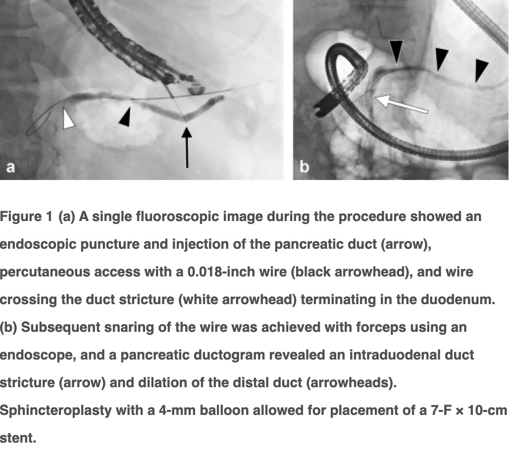Rendezvous Technique for Advanced Pancreatic Duct Interventions

<a href="/MdPanick/">Catherine (Rin) Panick</a> <a href="/Ryan_Schenning/">Ryan Schenning, MD</a> 

ow.ly/aF3N50L9pU6