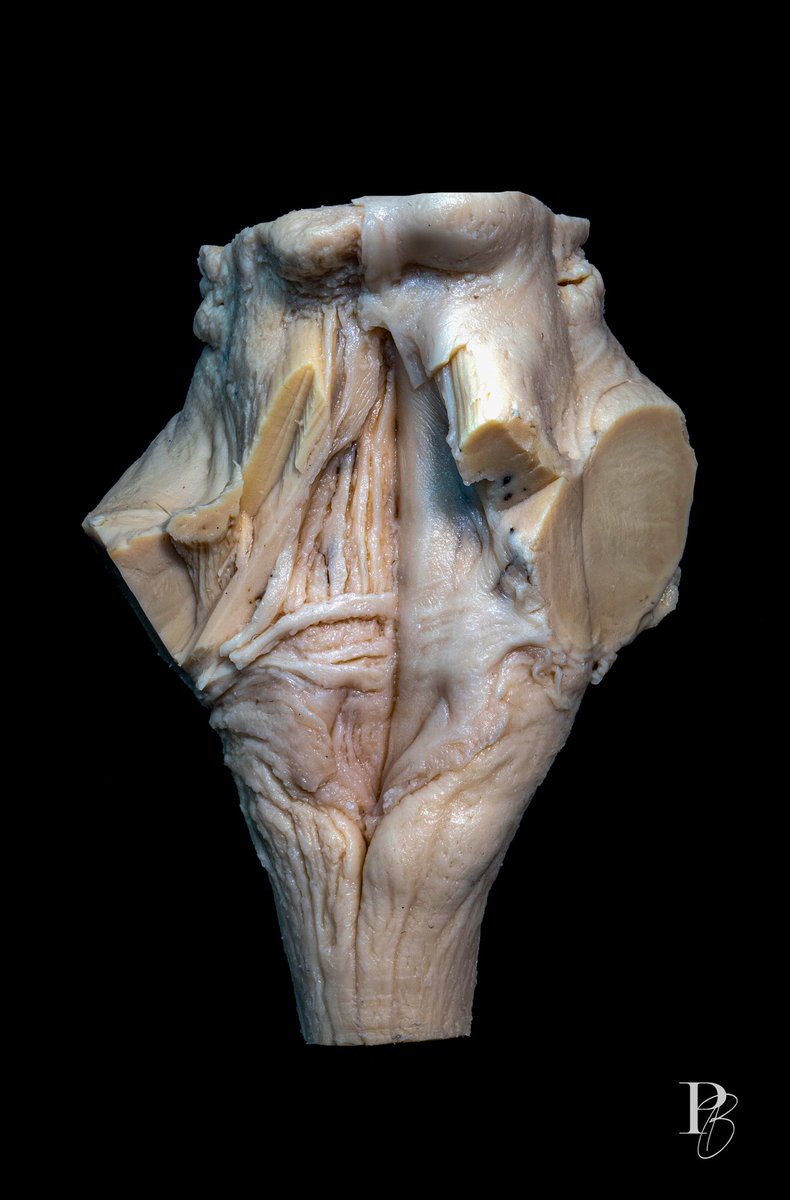 Floor of the fourth ventricle. #photobrain #neuroanatomy #Neurosurgery #neurotwitter #neuro