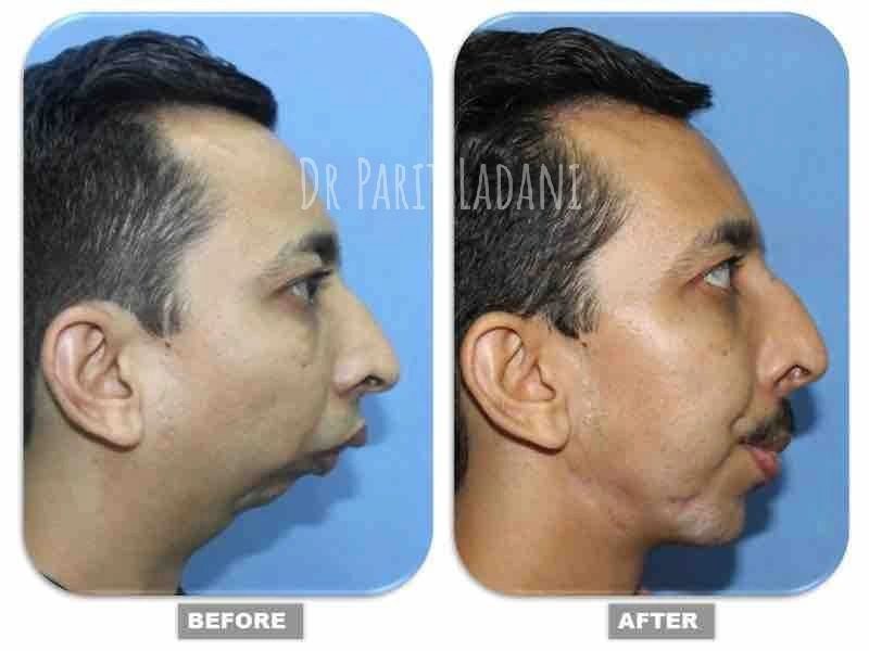 𝗠𝗮𝗻𝗱𝗶𝗯𝘂𝗹𝗮𝗿 𝗥𝗲𝘁𝗿𝗼𝗴𝗻𝗮𝘁𝗵𝗶𝗮

{For appointment : +91 9867472415}

For more information :👇
cleftsurgerymumbai.in/corrective-jaw…

#mandibularretrognathia #lowerjawsurgery #sleepapnea #genioplasty #bijawsurgery #jawsurgerysupportgroup #orthognathicsurgery #drparitladani #nuface