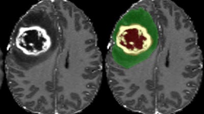 New publicly available MR images of diffuse #glioma: @UCSFimaging dataset doi.org/10.1148/ryai.2… @RadRudie @ujjwalbaid0408 @SpyridonBakas #NeuroRad #BrainTumor #AI