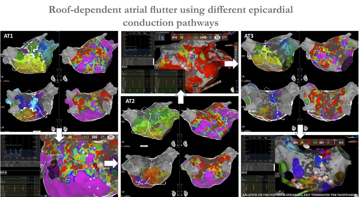 Dimitris Asvestas (@dimasvestas) on Twitter photo Roof-dependent atrial flutter with epicardial connections (previous PVI+PWI+AML 1y ago) with <a href="/SteliosTzeis/">Stelios Tzeis</a> an <a href="/V_Michopoulos/">Vassilis Michopoulos</a> EPLab <a href="/MiteraHospital/">Mitera</a> #epees Roof-dependent atrial flutter with epicardial connections (previous PVI+PWI+AML 1y ago) with <a href="/SteliosTzeis/">Stelios Tzeis</a> an <a href="/V_Michopoulos/">Vassilis Michopoulos</a> EPLab <a href="/MiteraHospital/">Mitera</a> #epees