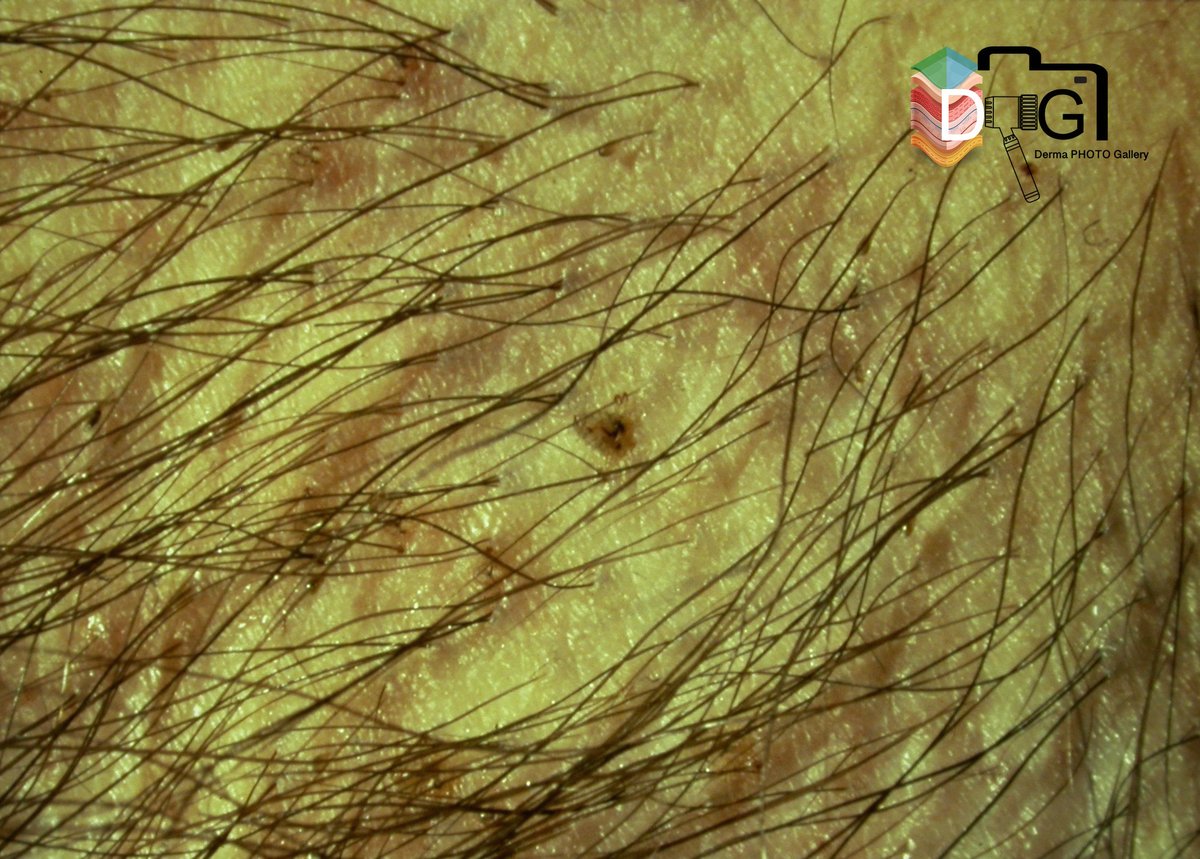 Derma_Photo's tweet photo. La pediculosis es la infestación de la piel por piojos. Se afecta la cabeza (capitis) o el cuerpo (corporis o pubis). Se transmite por personas infestadas en condiciones de hacinamiento (colegios) o si se comparten vestidos o artículos personales. https://t.co/MddvkeSzth
