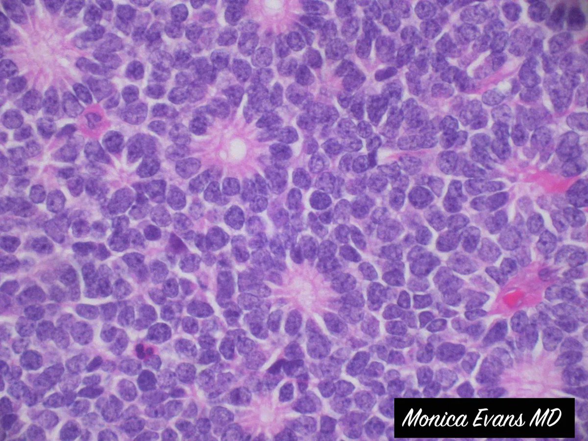 What are these classic ring-like structures? What tumor are they found in? Answer: kikoxp.com/posts/4321 #pathologists #pathology #pathTwitter #medstudents #MedStudentTwitter #USMLE #MedTwitter