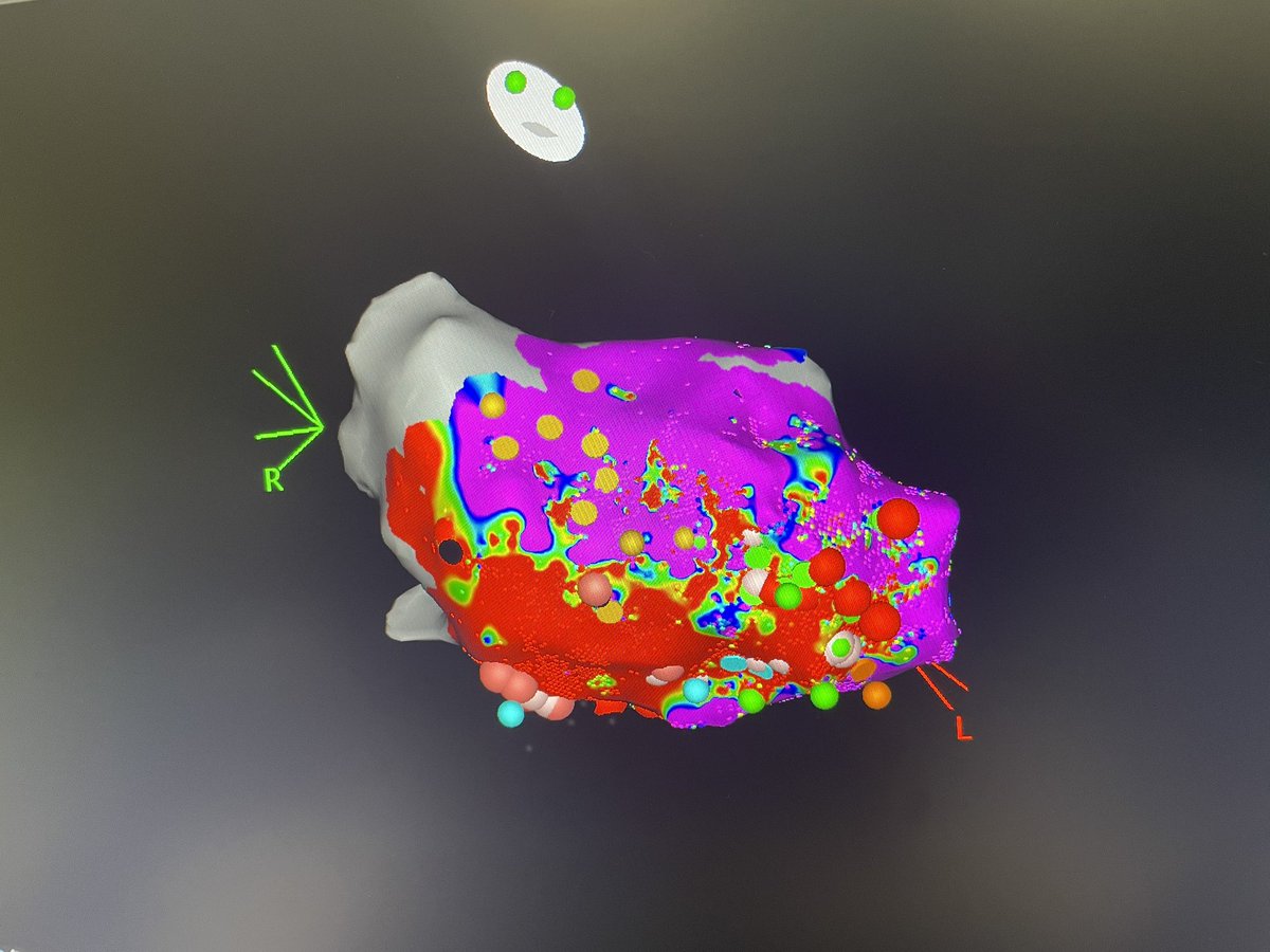 Dra_Jaurrigan's tweet photo. Super #VT substrate #ablation in sinus rhythm with my colleague @caruben89 at Miguel Servet Univ. Hospital. Old inferior AMI, incessant SMVT with basal inferoseptal exit site. Nice decremental EGMs. Non-inducible at the end. Thanks to @alegidop for tech assistance! #EPeeps https://t.co/mYDJx58Oe0