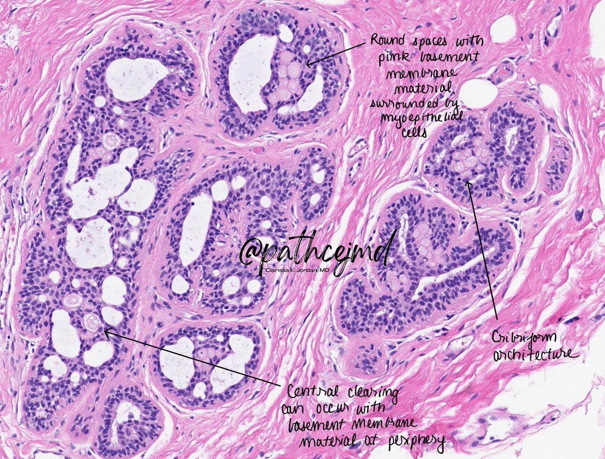 Just a nice example of this benign entity in the breast. What’s your diagnosis? #BreastPath