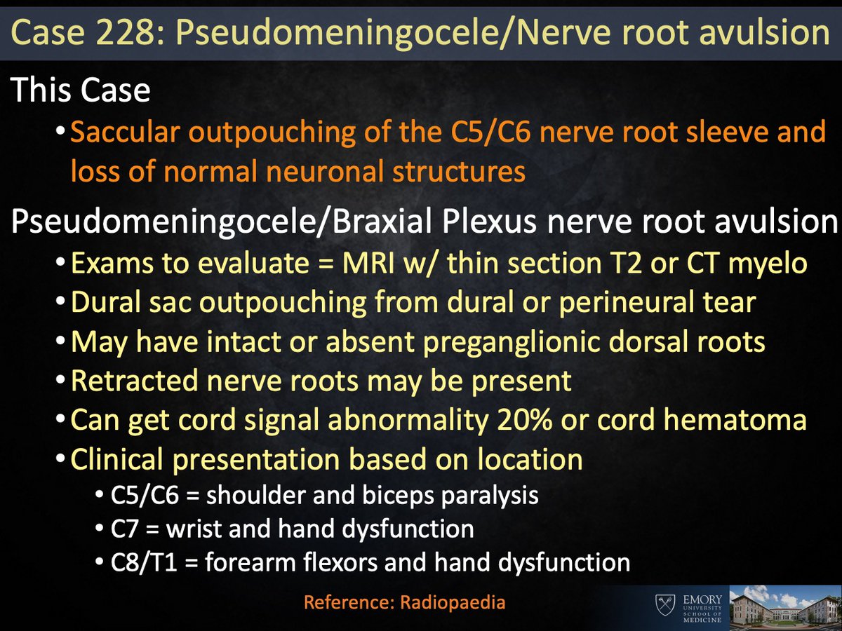 Answer: Pseudomeningocele from nerve root avulsion Pt had brachial plexopathy. Acute MRI was fairly unremarkable but sometimes takes time to see sleeve tear. Sac absent of normal nerve roots on symptomatic side. I thought this was an excellent case. #EmoryRadCOTD