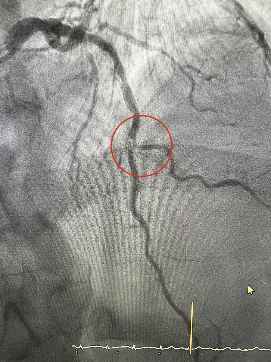 La importancia de la clínica y 👁️ en diabéticos…68 años, DM2, “quemazón epigástrica” al caminar de un mes de evolución, ECG y tropo normales. Dco de angina inestable: Cate…