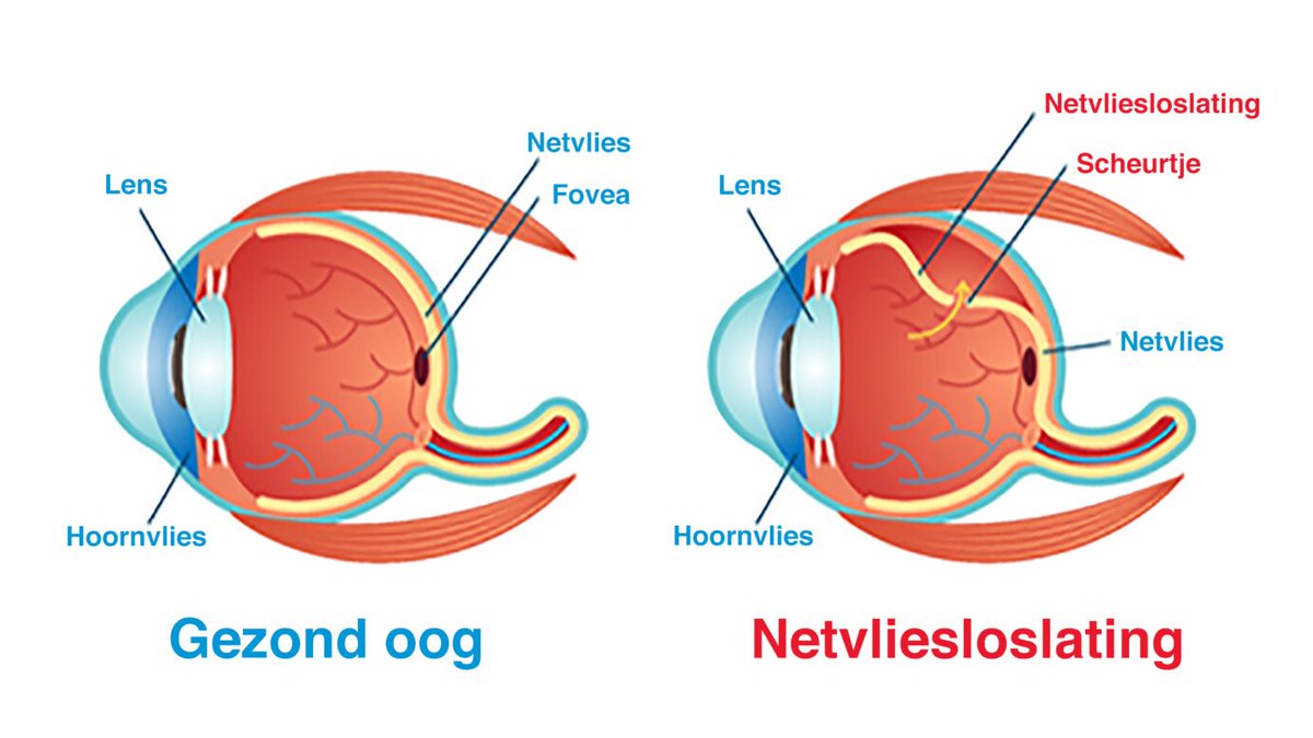 G11Sven's tweet photo. @hopsakidee Waarschijnlijk door micro-stolsels in de kleine bloedvaten vd netvliezen, veroorzaakt door de V-injectie(s).
Netvlies weer op z'n plek gebracht: injectie met olie.
Operatie onder #volledige narcose stelt niets voor.
Alleen: gezien laatste 3 jaar vertrouw ik #nul artsen meer. https://t.co/ukvWG7S8qk