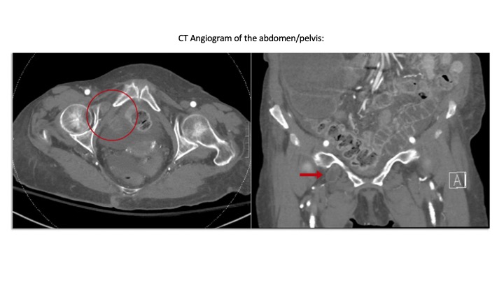 TSACO_AAST's tweet photo. #WWYDWEDNESDAYS! π€
β’ Case: 80F in ED with 1 day of severe abd pain, nausea, emesis.
β’ Exam: abdomen is soft, distended, non-tender, no peritonitis.
β’ Labs remarkable for: WBC 19, lactate 3.3
β’ CT angiogram attached.
WWYD?
#TSACOGlobal #SoMe4Surgery #AcuteCareSurgery https://t.co/Cl5VUuHhel