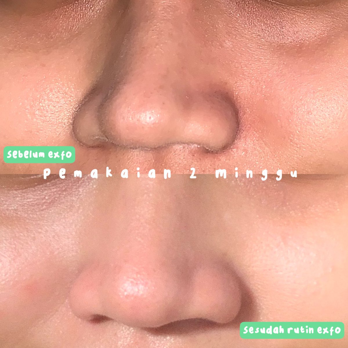 hmtly's tweet photo. Kalau exfo rutin pasti hasilnya selalu bagus 😭🫶

Bisa kalian cek unclogged pores &amp; irritated skin ku berkurang, pores juga lebih halus banget! 

#racuninskincare https://t.co/qs73QxHv00