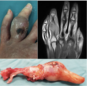 JOrthopedics's tweet photo. A Case Report and Brief #Literature #Review on #Dedifferentiated #Chondrosarcoma in #Proximal Phalanx: A Rare Location.
Dedifferentiated chondrosarcoma (DDCS) is a rare entity, constituting only 1-2% of all primary bone tumors, and has a dismal prognosis. 
#Enchondroma
#joo 
#USA https://t.co/j4ET2stn6x