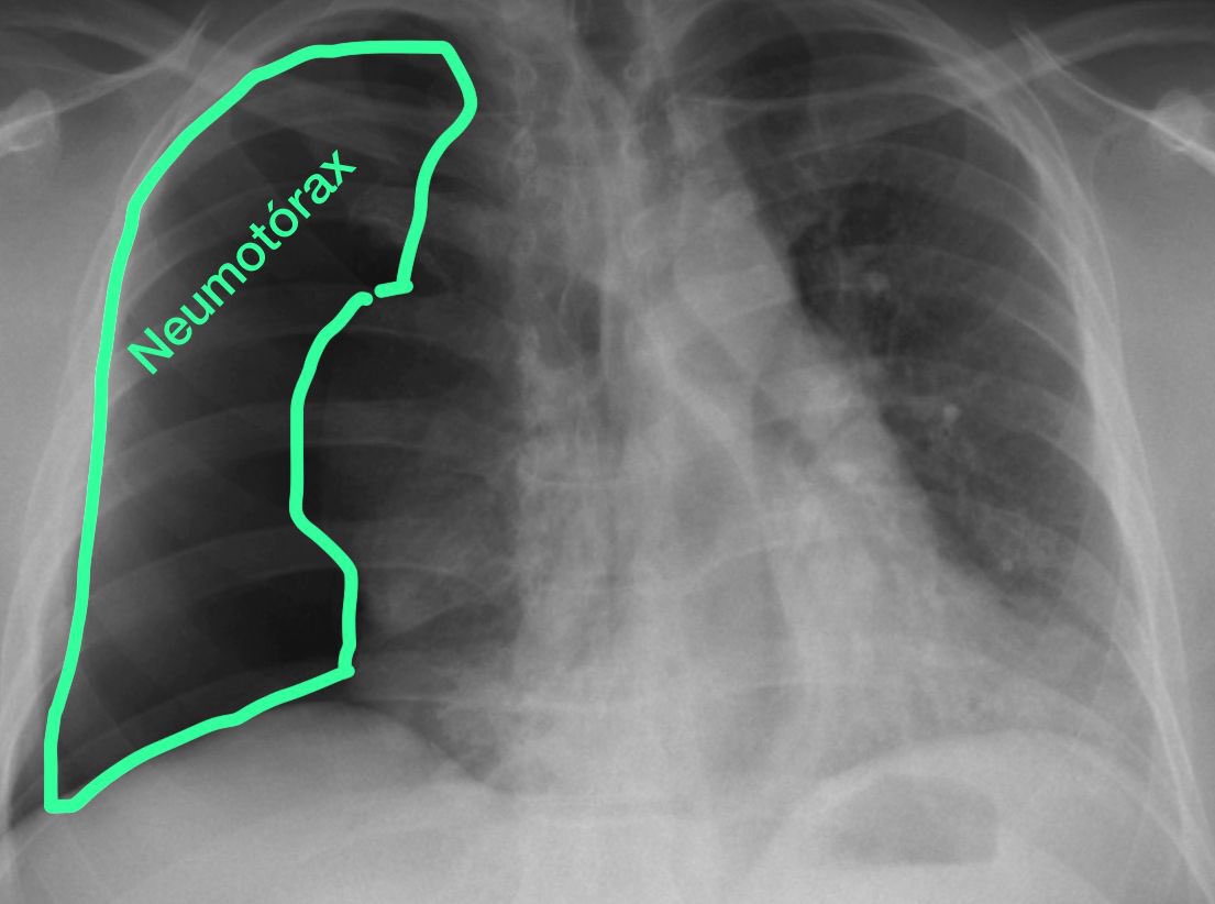 TradrBravo's tweet photo. En neumología, ojo al traducir «lung collapse». Puede ser «neumotórax» (entrada de aire en la cavidad pleural) o «atelectasia» (colapso o expansión incompleta del pulmón). No es lo mismo y es necesario conocer el contexto.
#medicaltranslation #traduccionmedica #lungcollapse https://t.co/RstDFIJ4IS