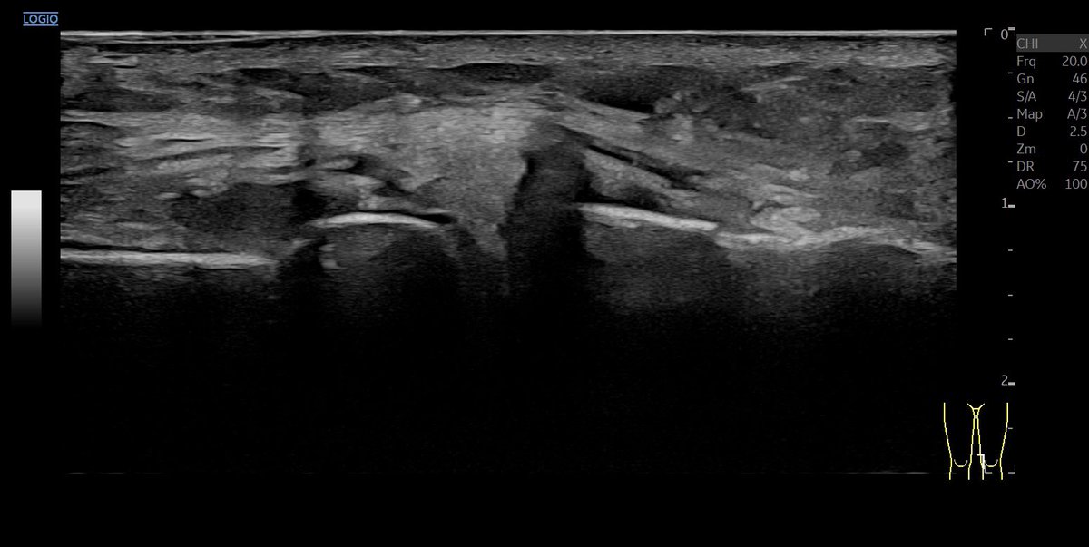 Medial horizontal #meniscustear in #mskus with #xdclearultrasound #pocus #pocushub #GElogiqE10r3
