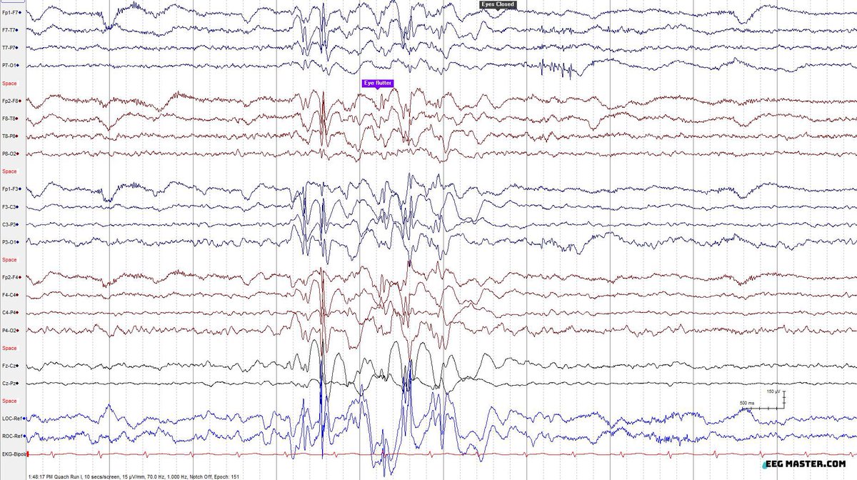 A. Eyelid myoclonia without ictal discharges 
 B. Eyelid myoclonia with ictal discharges 
 C. Chewing artifact 
 D. Generalized rhythmic delta activity
