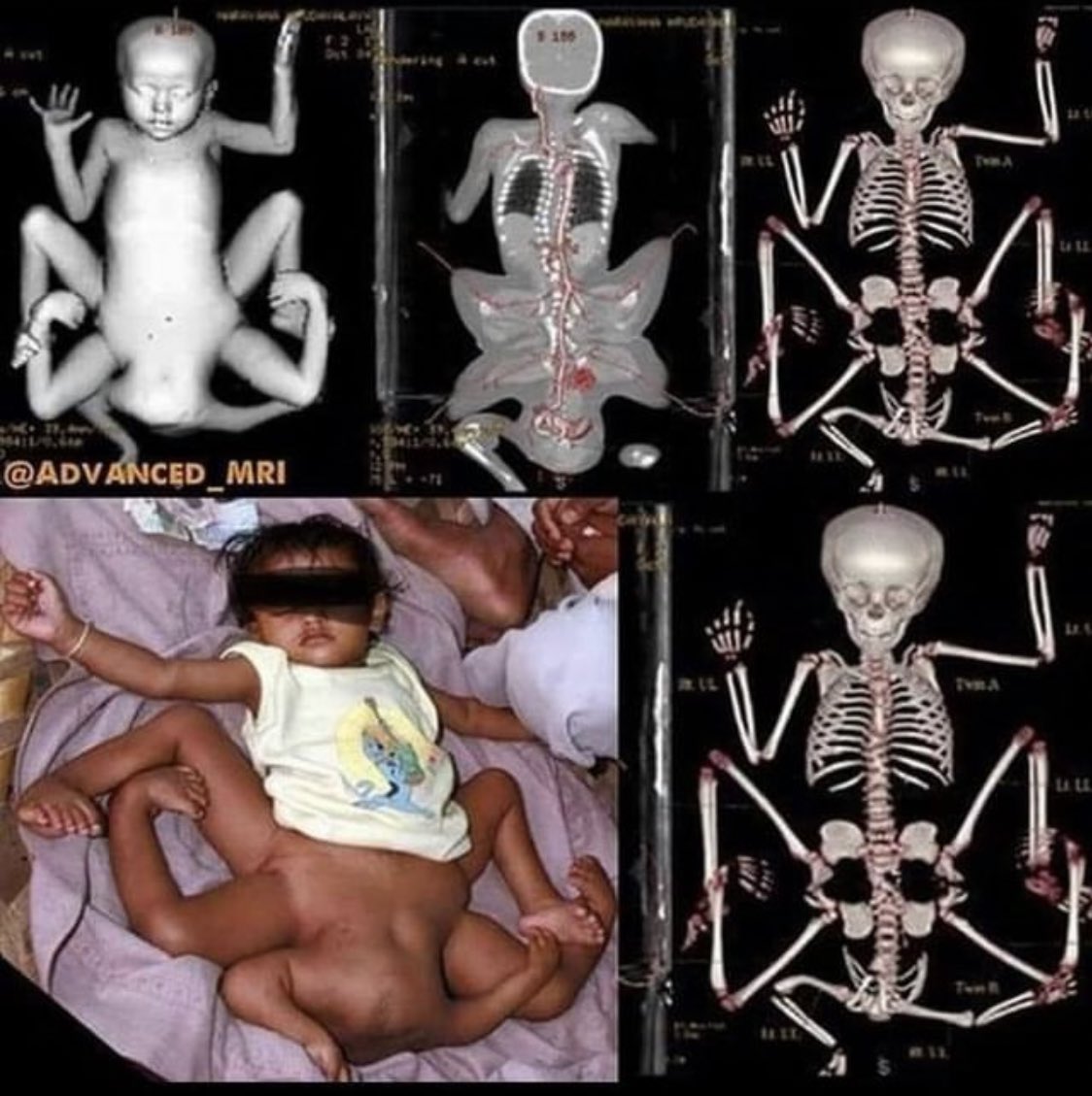 XrayProblems's tweet photo. ischiopagus conjoined twins
#radiology #xray #conjoinedtwins #medtwitter #xrayprobs #ctscan https://t.co/TMPENWPMjF