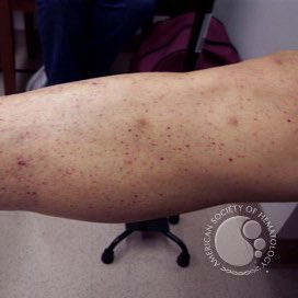 Petechiae