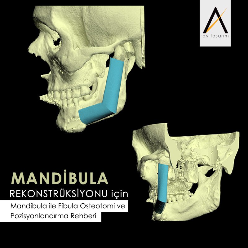 aytasarim's tweet photo. Mandibula Rekonstrüksiyonu için Mandibula ile Fibula Osteotomi ve Pozisyonlandırma Rehberi 🎈 @ayberkyagiz https://t.co/NQnOHoDD82