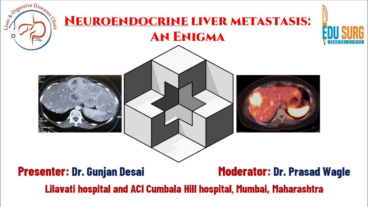 edusurg_clinics's tweet photo. Small Intestinal Neuroendocrine Neoplasm With Liver Metastasis - A Case Based Discussion. Click here to watch full Video: https://t.co/MKHqj0TH4S | https://t.co/U8IWOMiLtH
#intestines #colon #smallintestinal #liver #livermetastasis #surgeon #surgery #Edusurgclinics https://t.co/wkzihzAxbP