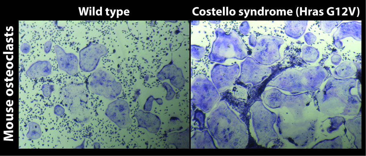 Oncogenic #Hras G12V enhances #osteoclastogenesis and contributes to #osteoporosis in a #CostelloSyndrome mouse model, new publication by <a href="/CirsteaLab/">CirsteaLab</a>. #Small #GTPase #HRAS function as #osteoclast regulator. doi.org/10.3389/fcell.…