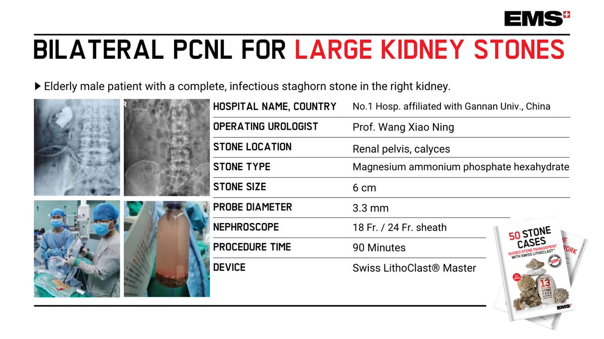 #PCNL for complete staghorn stone: Elderly male patient with a complete, 6cm, infectious staghorn stone in the right kidney. Swiss #LithoClast Master helped clear it out: okt.to/LVaeGc Video courtesy of Prof. Wang Xiao Ning, No.1 Hosp. / Gannan Univ., China