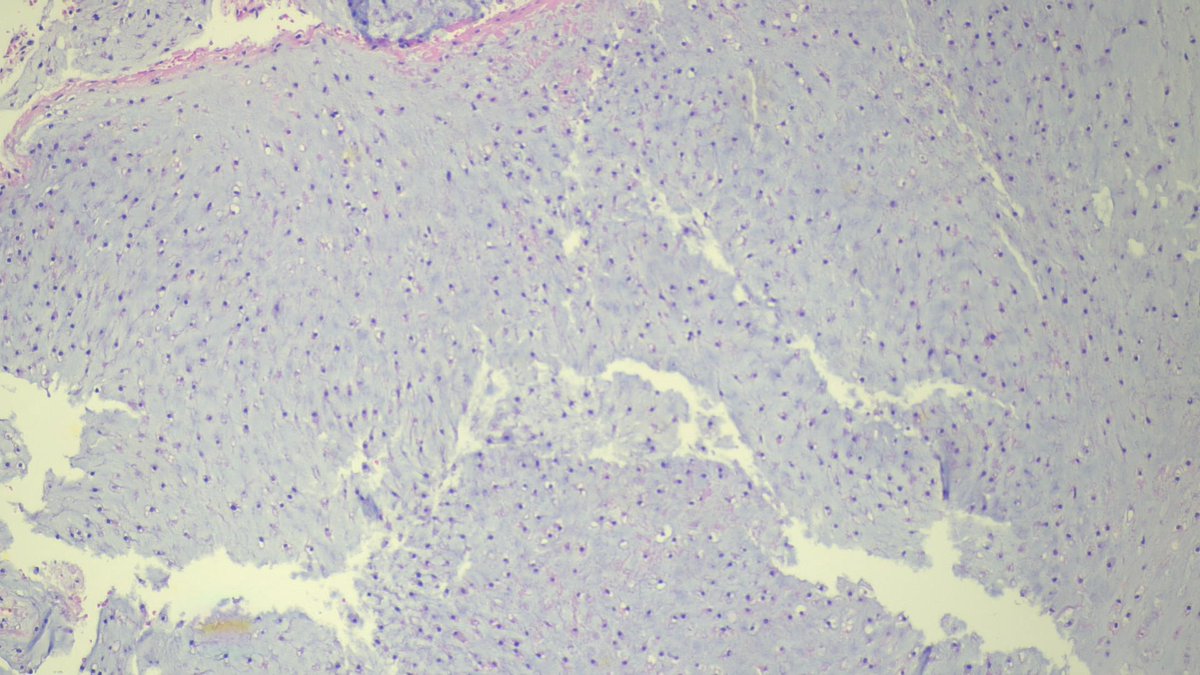 CPathig's tweet photo. 50 year-old female with a two-year hx of R eye peripheral vision loss. Brain MRI revealed a 5.3 x 5.1 cm multilobulated central/right skull base mass with extension to the sphenoid sinus. Transsphenoidal biopsy revealed the following. Diagnosis? Answer: https://t.co/BOsSdfeC4R https://t.co/lPT3GghMpV
