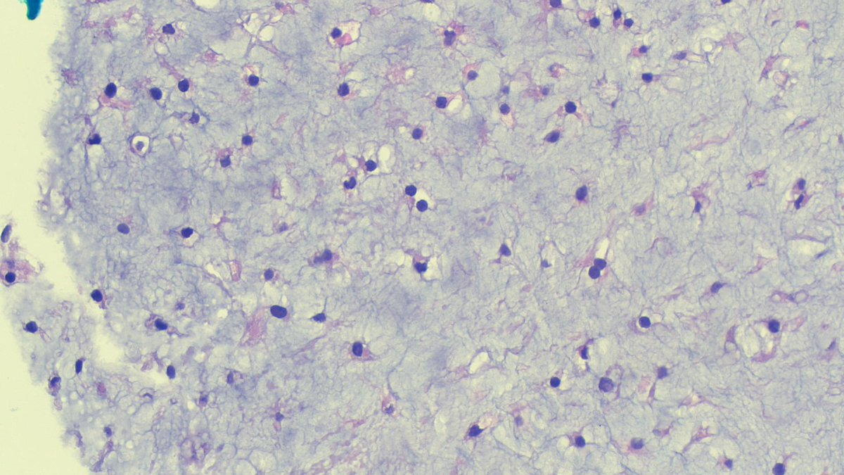 CPathig's tweet photo. 50 year-old female with a two-year hx of R eye peripheral vision loss. Brain MRI revealed a 5.3 x 5.1 cm multilobulated central/right skull base mass with extension to the sphenoid sinus. Transsphenoidal biopsy revealed the following. Diagnosis? Answer: https://t.co/BOsSdfeC4R https://t.co/lPT3GghMpV