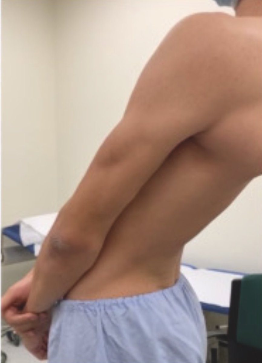 ParkinsonismD's tweet photo. A man with an arched back #movementdisordersround #DYT1 #opisthotonos #axialposturalabnormalities https://t.co/P034mNBUEZ. Expert commentary https://t.co/yOjFog3xK7 https://t.co/ZEpZJ9btOR