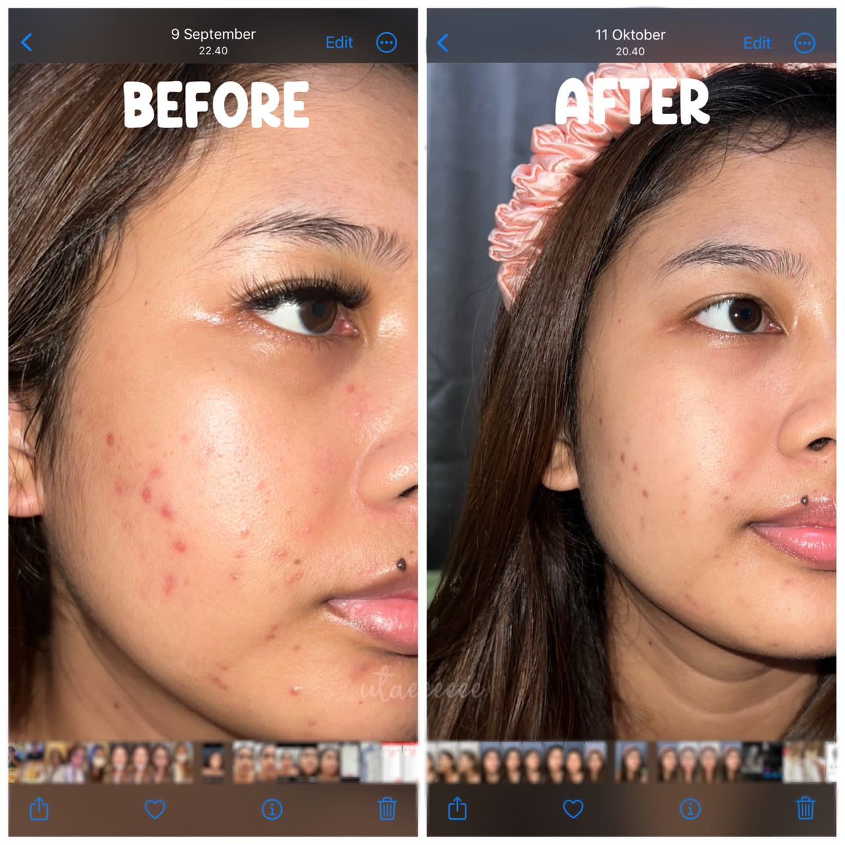 utaeeeeee's tweet photo. liat perbedaan jerawatku udah mendingan bgt😭 aku udah repurchase serum Garnier Bright Complete Anti Acne Booster Serum ini karena serum ini tuh ampuh banget dan punya 2 fungsi melawan jerawat dan mencerahkan noda bekas jerawat 🥺
#BEBASDRAMAJERAWAT #DRAWAT #racuninskincare https://t.co/TcalCVVVFG