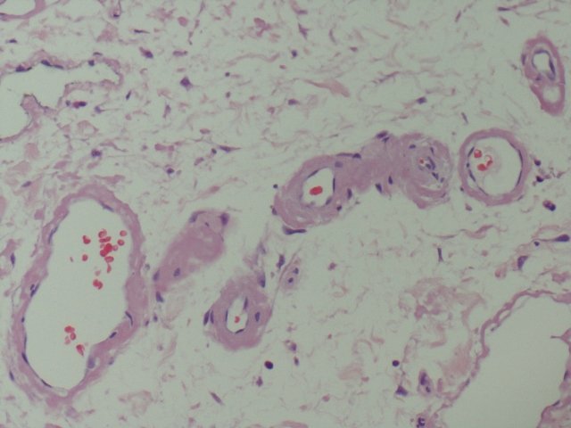 A 72 year old man, known to have diabetes mellitus, hypertension and end stage kidney disease on hemodialysis, presented with massive tongue enlargement and difficulty in swallowing. 
What is your opinion?
#Oralpath
#Hemepath
#HeadNeckpath
#Pathology
#Pathtwitter